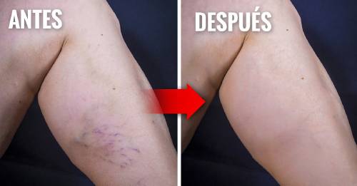 Cuanto más alto seas, más probable es que desarrolles varices