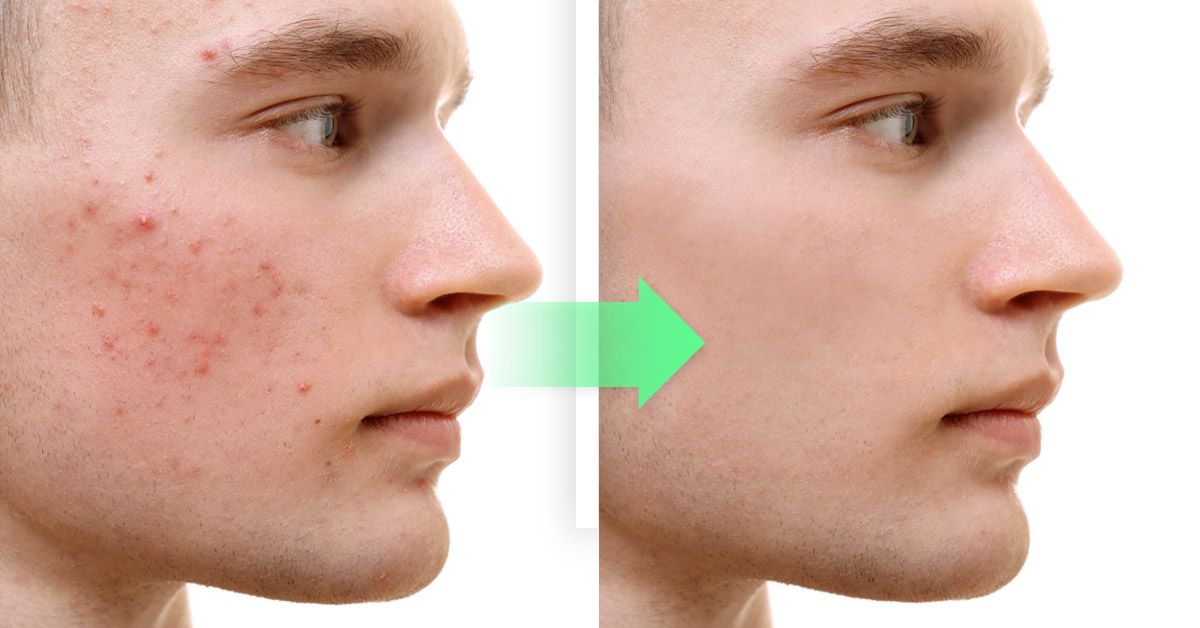 Permeabilidad Mata Subir Eliminar el acné de manera natural con aloe vera | Bioguia
