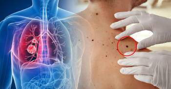 tipos de cancer mas comunes, cancer de pulmon y cancer de piel