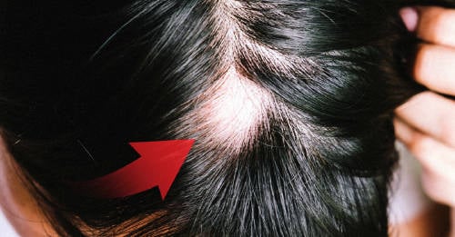alopecia todo deberias saber ¿Qué significa y cómo decodificar la caída del cabello?