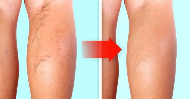 várices 3 arañitas en las piernas