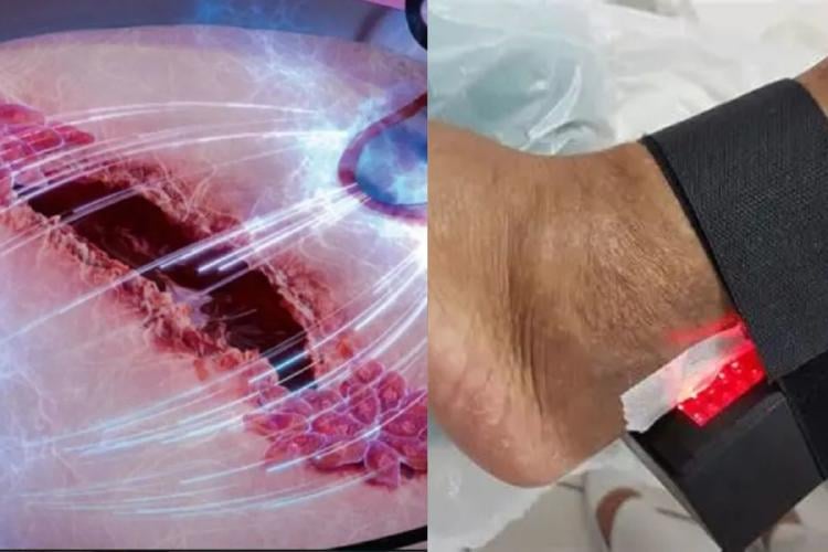 dispositivo cicatrices La tecnología combina una biomembrana de látex natural y un panel de luz LED roja de baja intensidad, y mostró resultados superiores al tratamiento convencional.