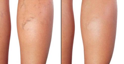 Varises antes y después Varises antes y después