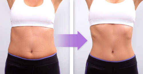 flacidez abdominal causas ejercicios flacidez abdominal causas ejercicios