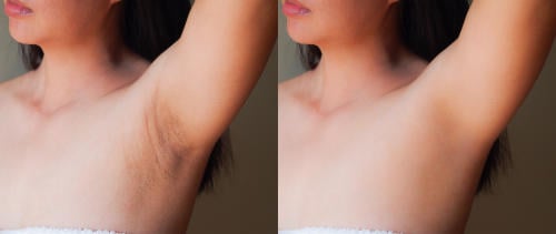 cuidado corporal axilas manchadas cuidado corporal axilas manchadas