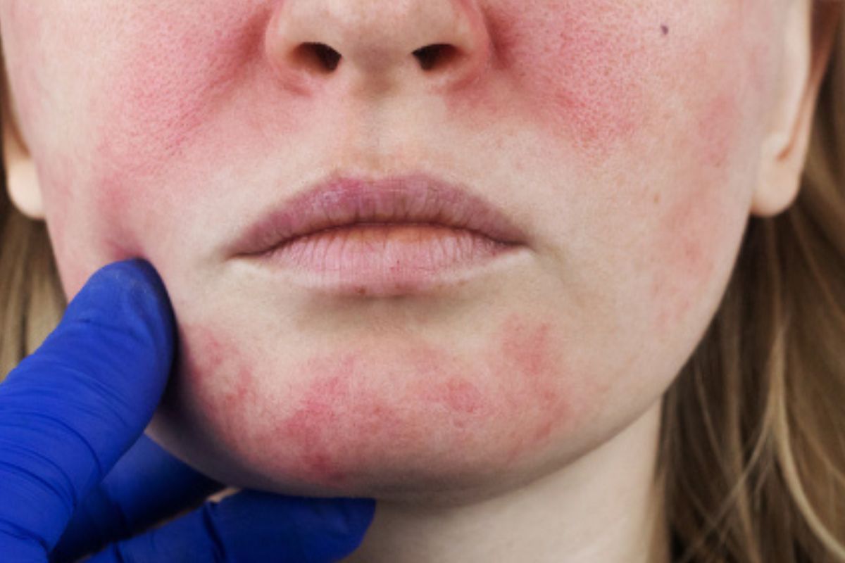 Qué es el “niacin flush” y por qué produce enrojecimiento (Imagen: jinfiniti.com)