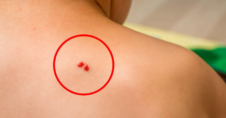 lunares rojos en la piel 4 lunares rojos en la piel
