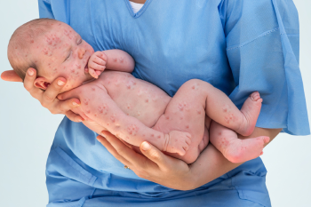 bebe sarampion El sarampión, una enfermedad que se puede evitar con una simple vacuna, volvió y avanza en todos los continentes. (Fuente: movidasana.com)