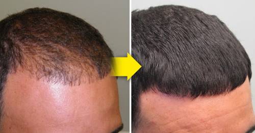 5 consejos que ayudan a prevenir y demorar la calvicie 5 consejos que ayudan a prevenir y demorar la calvicie