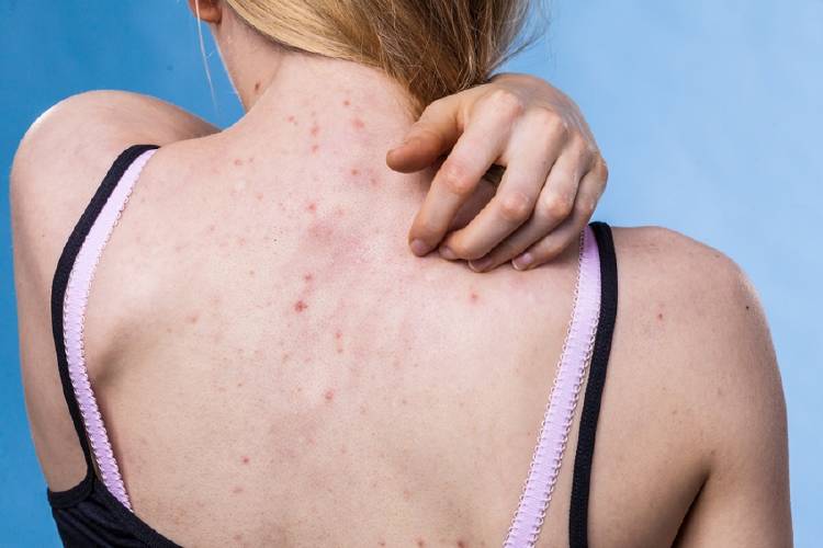 mujer joven con acne en la espalda