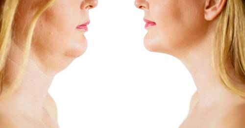 Esto es lo que debes hacer para eliminar la grasa en el cuello Esto es lo que debes hacer para eliminar la grasa en el cuello