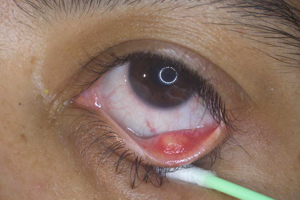 orzuelo interno Orzuelo interno: qué es, síntomas y cómo tratarlo