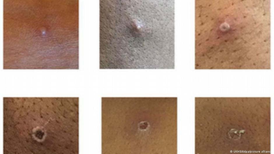 Viruela del mono Lesiones en la piel producidas por la viruela del mono.