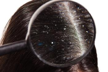 caspa cabello cuero cabelludo caspa cabello cuero cabelludo