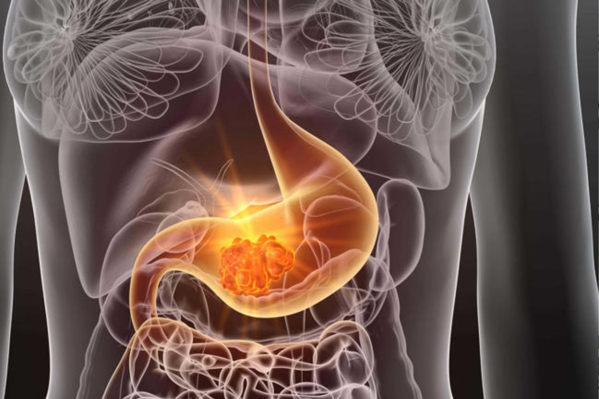 bacteria La bacteria Helicobacter pylori se transmite principalmente a través de agua y alimentos contaminados, y su tratamiento habitual consiste en el uso de antibióticos (Alamy/PA) (Fuente: MSN)