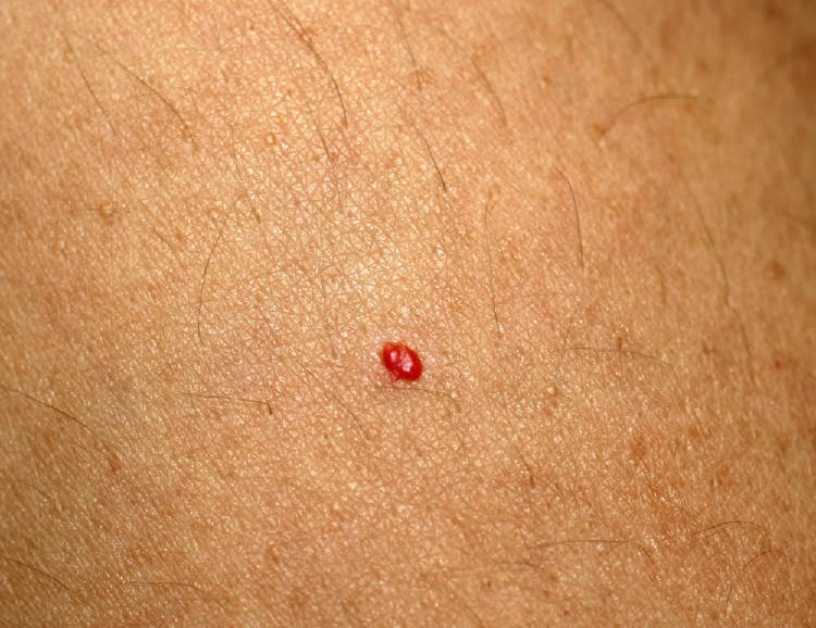 Lunares rojos en la piel