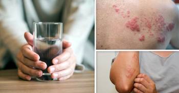 Alergia al agua: así es esta rara enfermedad y así sobrevive una de las pocas mujeres en el mundo que la sufre