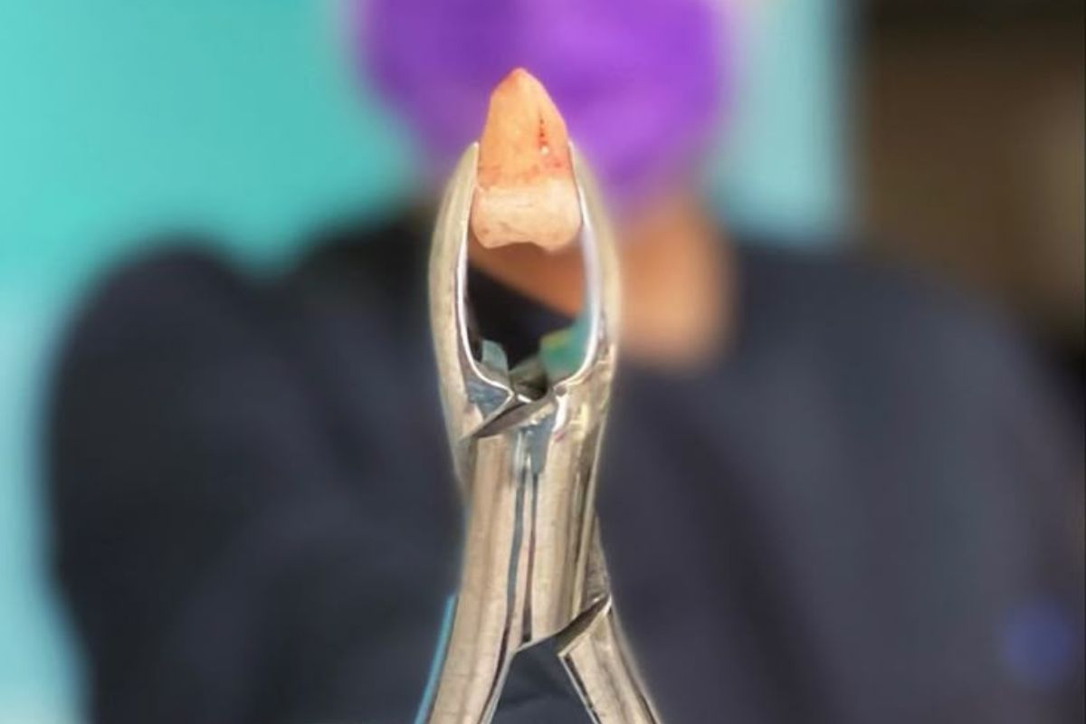 muela del juicio muela del juicio