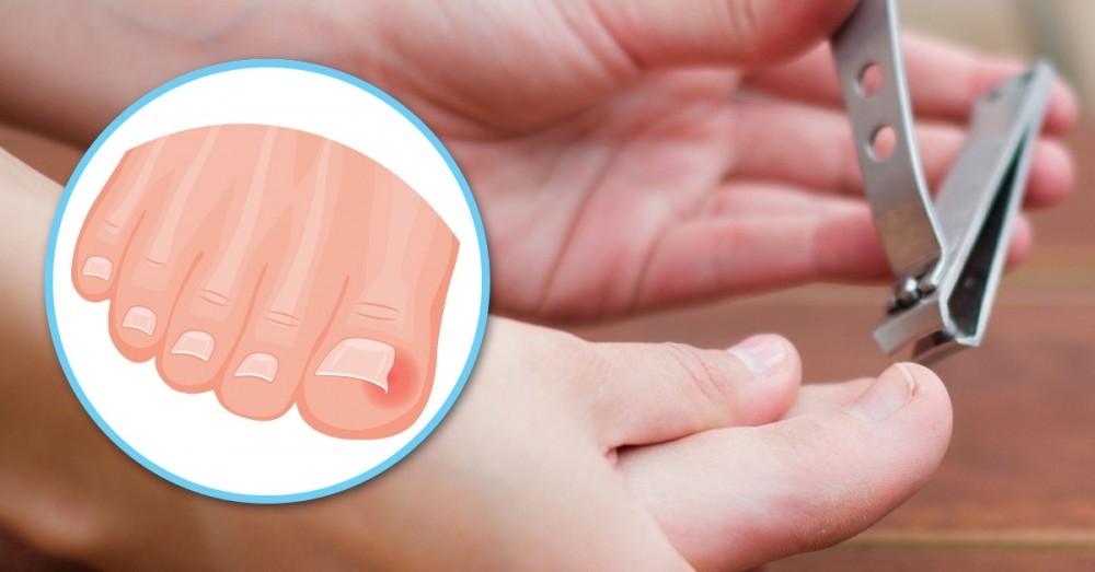 Cómo curar las uñas encarnadas tú mismo de 5 formas | Bioguia