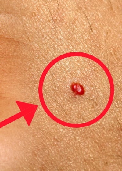 Enterate Que Hay Detras De Los Puntos Rojos Que Salen En La Piel Bioguia Enterate Que Hay Detras De Los Puntos Rojos Que Salen En La Piel Bioguia