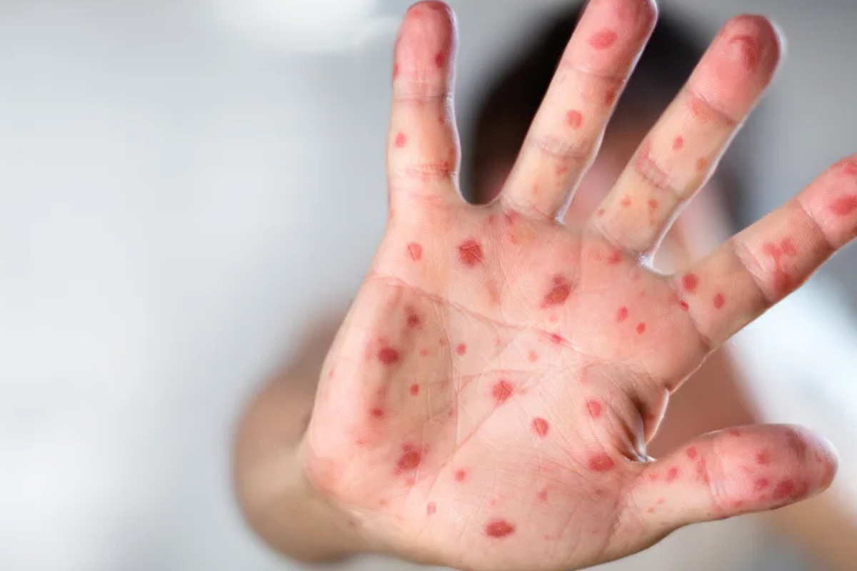 viruela del mono Vuelve una amenaza del pasado: la Organización Mundial de la Salud (OMS) emite alerta este miércoles sobre la notificaron de casos de mpox anteriormente viruela del mono. (Foto: CNN)