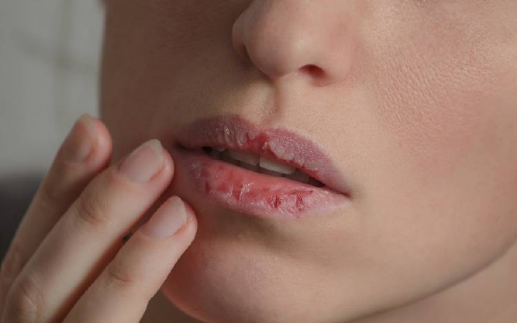 labios agrietados labios agrietados