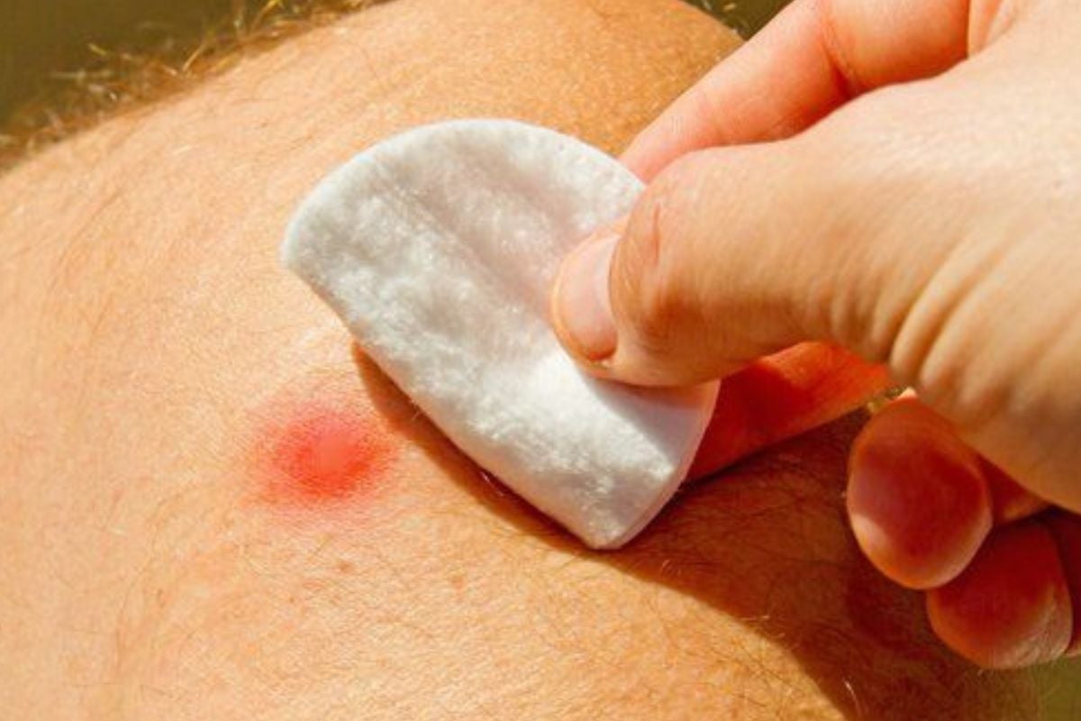 forunculo Los forúnculos pueden generar una bacteria peligrosa —como Staphylococcus aureus— porque son infecciones profundas de los folículos pilosos. (PINTEREST)