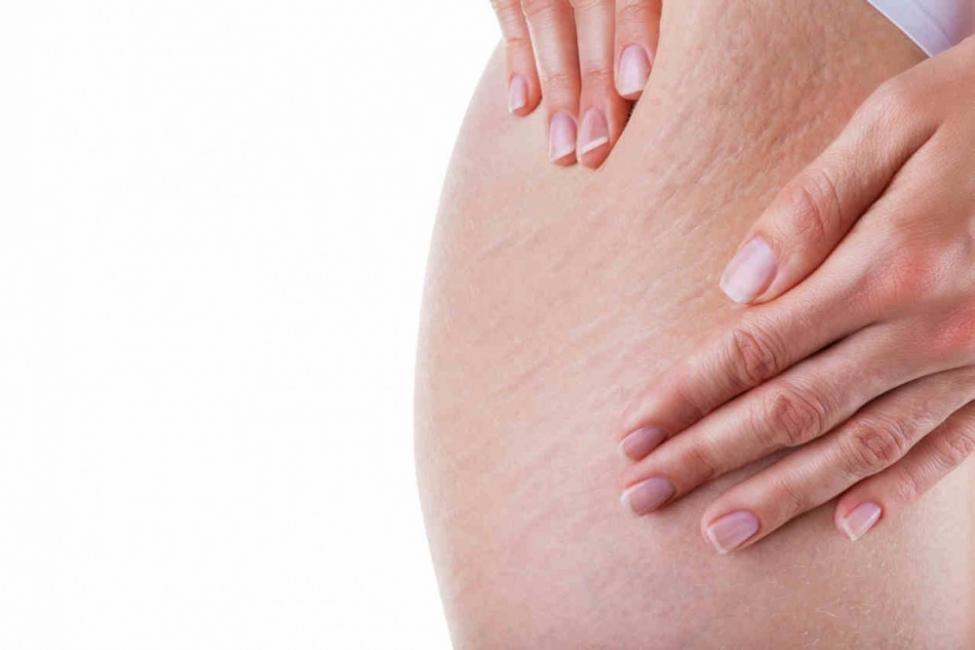 lipedema lipedema