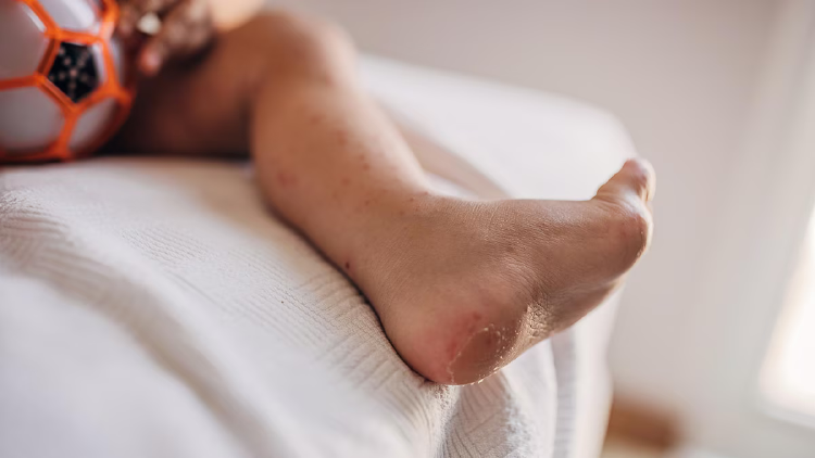 VIRUS NIÑOS No existe un tratamiento antiviral específico para las infecciones por Coxsackie, y el manejo se centra en aliviar los síntomas y prevenir complicaciones. (infobae)