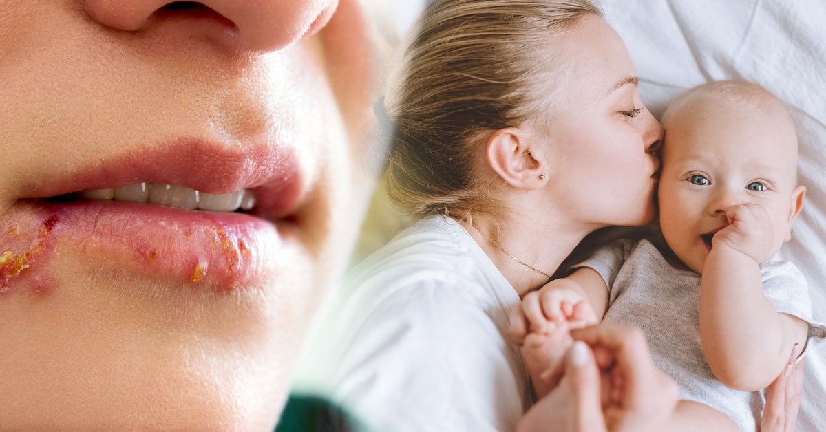 El Herpes Puede Ser Muy Peligroso En Bebes Y Se Transmite Por Los Besos Asi Puedes Evitarlo Bioguia