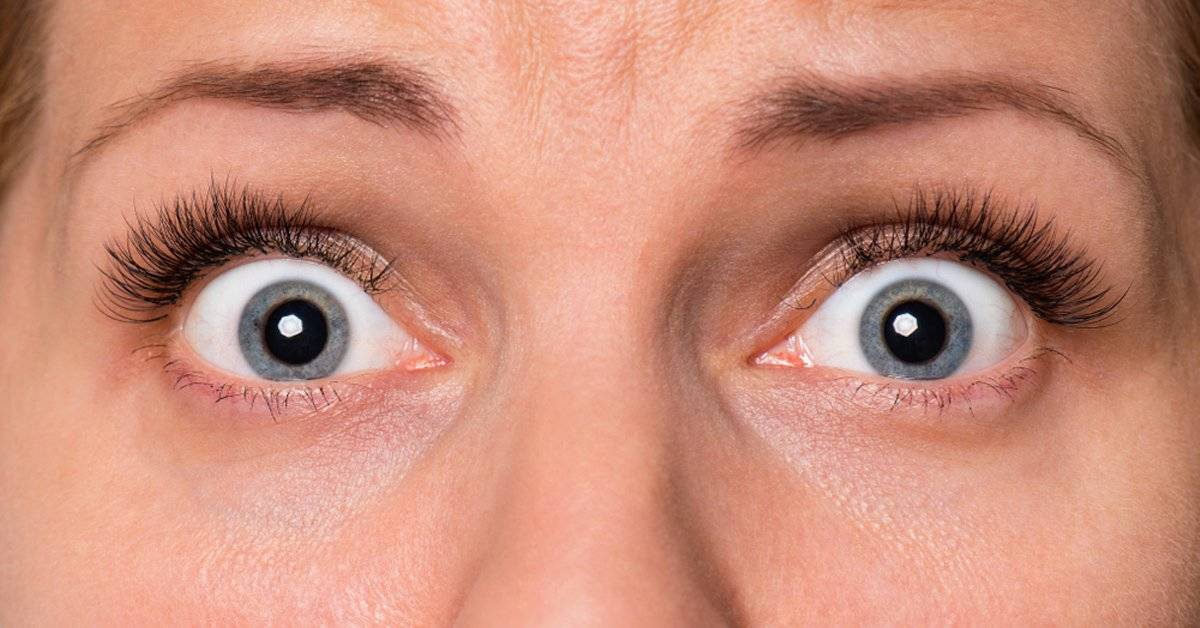 Que Significan Los Lunares En Los Ojos Consejos Ojos