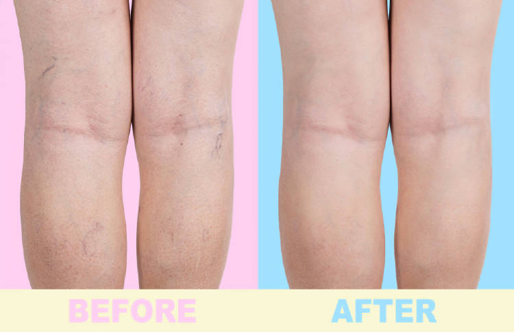 Ejercicios para combatir las varices Ejercicios para combatir las varices