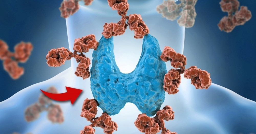 ¿Qué Es El Síndrome De Hashimoto Y Cómo Saber Si Lo Tienes? | Bioguia