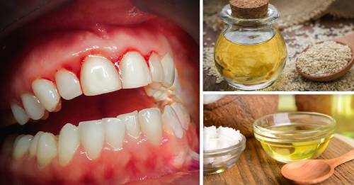 4 remedios naturales infalibles para reducir el sangrado de tus encías