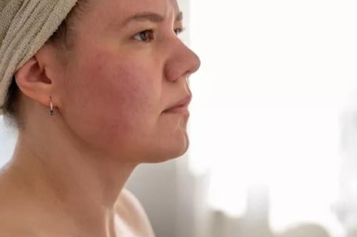 enrojecimiento Imagen: www.health.com