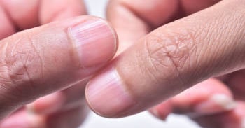 lineas en las uñas Por qué salen líneas en las uñas y cómo eliminarlas naturalmente