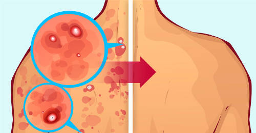 8 trucos deshacerte espinillas espalda 8 trucos deshacerte espinillas espalda