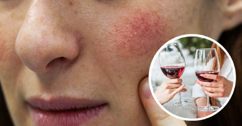 ¿Te sonrojas cuando bebes alcohol? Lee esto por tu salud