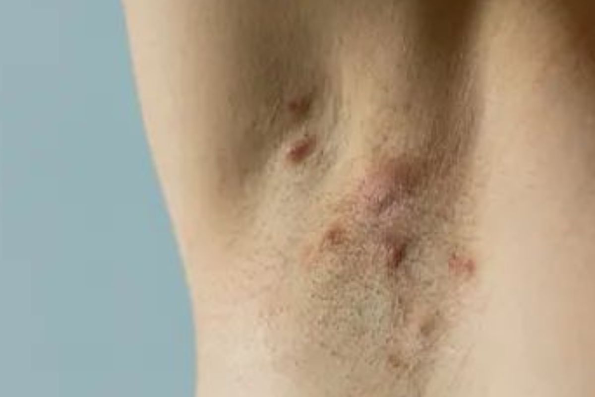 a nicotina y otros componentes del humo podrían actuar sobre los receptores de acetilcolina en queratinocitos, sebocitos, células inmunitarias y folículos pilosos, promoviendo hiperqueratosis (Pinterest)