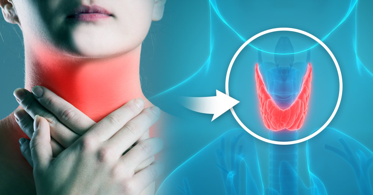 Qué es el hipotiroidismo: conoce sus síntomas para saber si puedes tenerlo Qué es el hipotiroidismo: conoce sus síntomas para saber si puedes tenerlo
