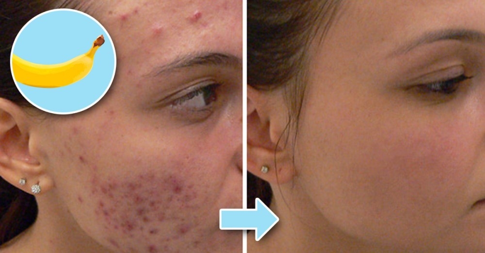 Cómo quitar acné hinchazón de la piel con cáscaras de | Bioguia