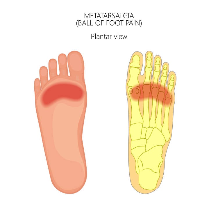 Metatarsalgia o dolor en la bola del pie