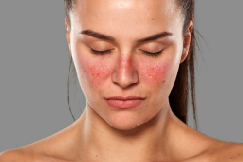 mujer con enfermedad piel Alerta: tu piel paga la factura de la crisis climática. (Imagen: ciosalud.com)