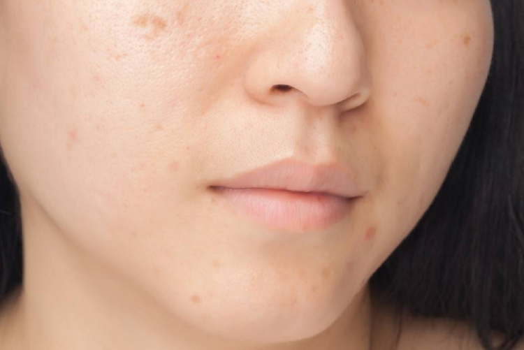 mancha de la cara 1 manchas de la cara