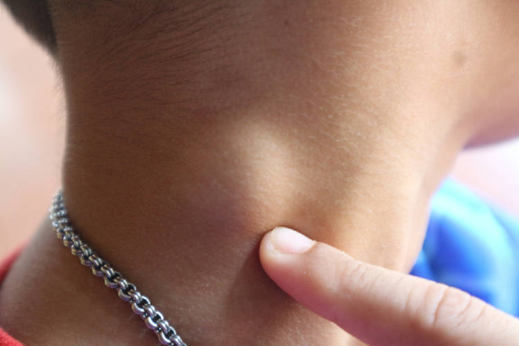inflamación de los ganglios señales del cuerpo para evitar el cáncer