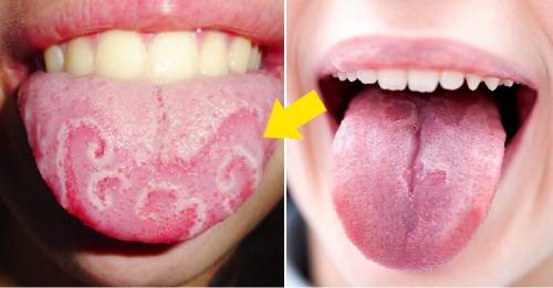 Qué es esta extraña afección en la lengua que tienen algunas personas, y cómo deshacerse de ella Qué es esta extraña afección en la lengua que tienen algunas personas, y cómo deshacerse de ella