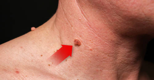 significado verrugas cuello significado verrugas cuello