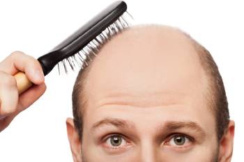 calvicie alopecia