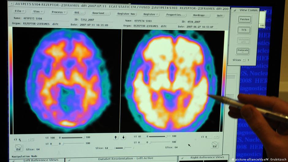 Imágenes del computadora de cerebro con Alzheimer Imágenes en computador de una persona sana (izq.) y otra con Alzheimer.