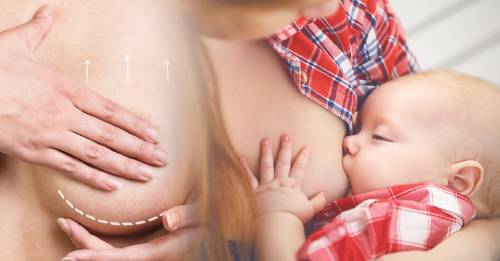 ¿Se puede dar el pecho naturalmente con prótesis de silicona? ¿Se puede dar el pecho naturalmente con prótesis de silicona?